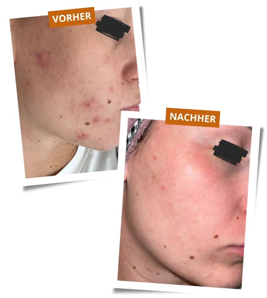 Vorher-Nachher-Ergebnis einer Klientin